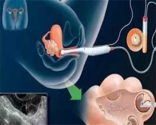 上海试管代孕正规医院,试管婴儿的适应症和禁忌症_上海供卵试管医院吗-上海哪